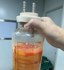 五家渠水动力吸脂手术要做多久？